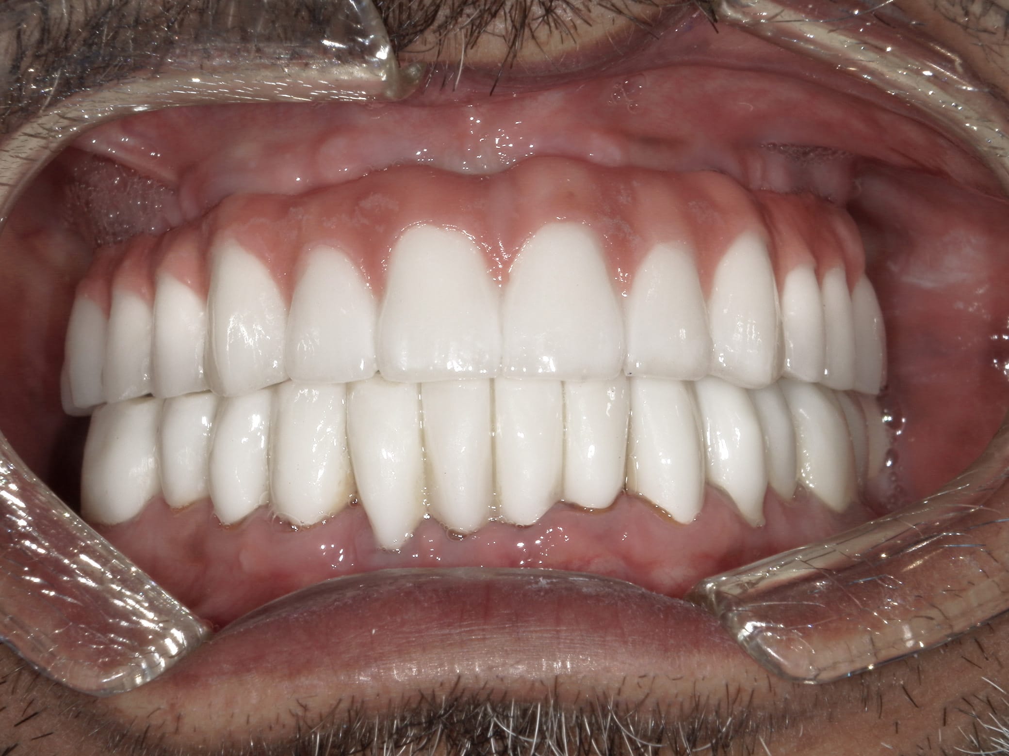 image of teeth after a dental implant