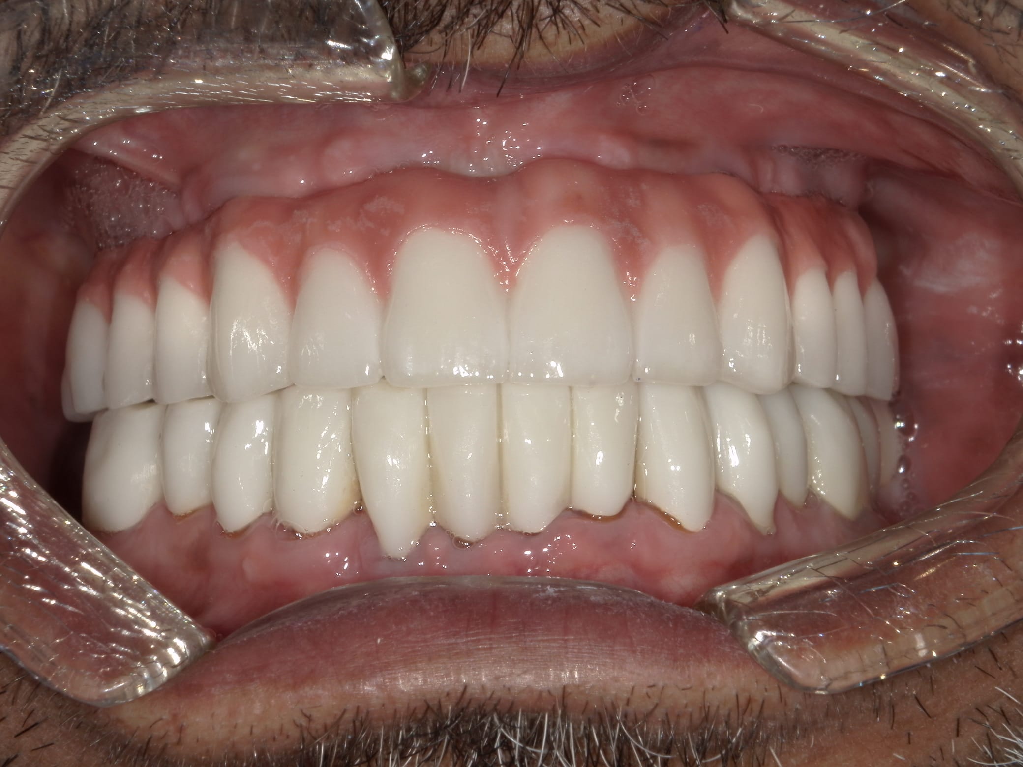 image of teeth after a dental implant