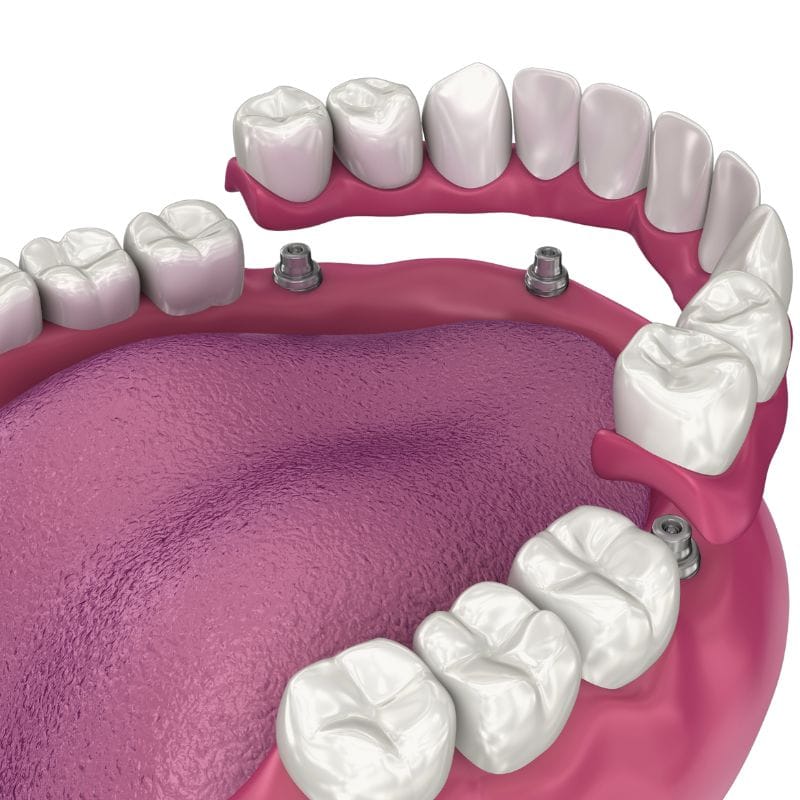 image of teeth after a dental implant in Tijuana