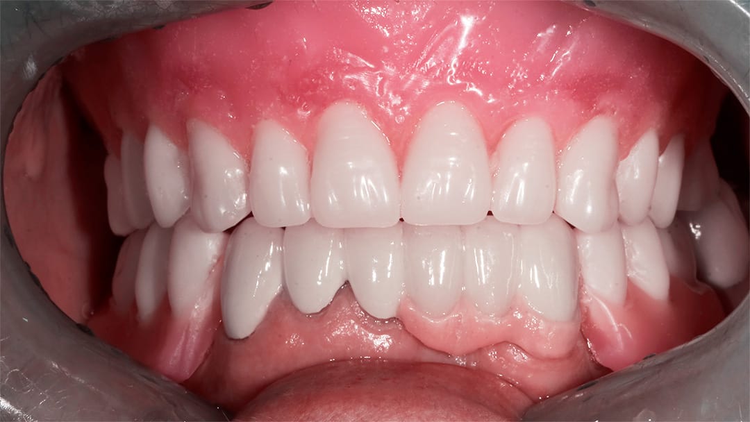 image of teeth after a all on 4 dental implant Mexico