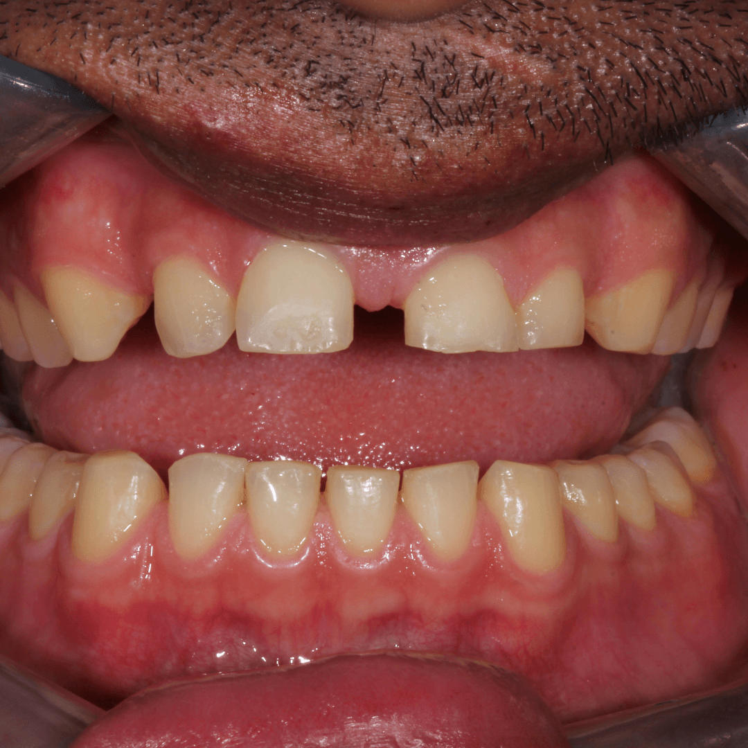 Dental Veneers Before Tijuana 01