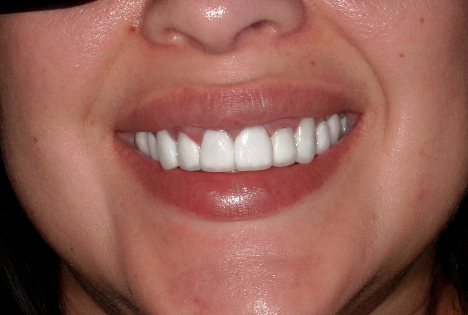 Close up women smiling with good denture after all on4 dental implants