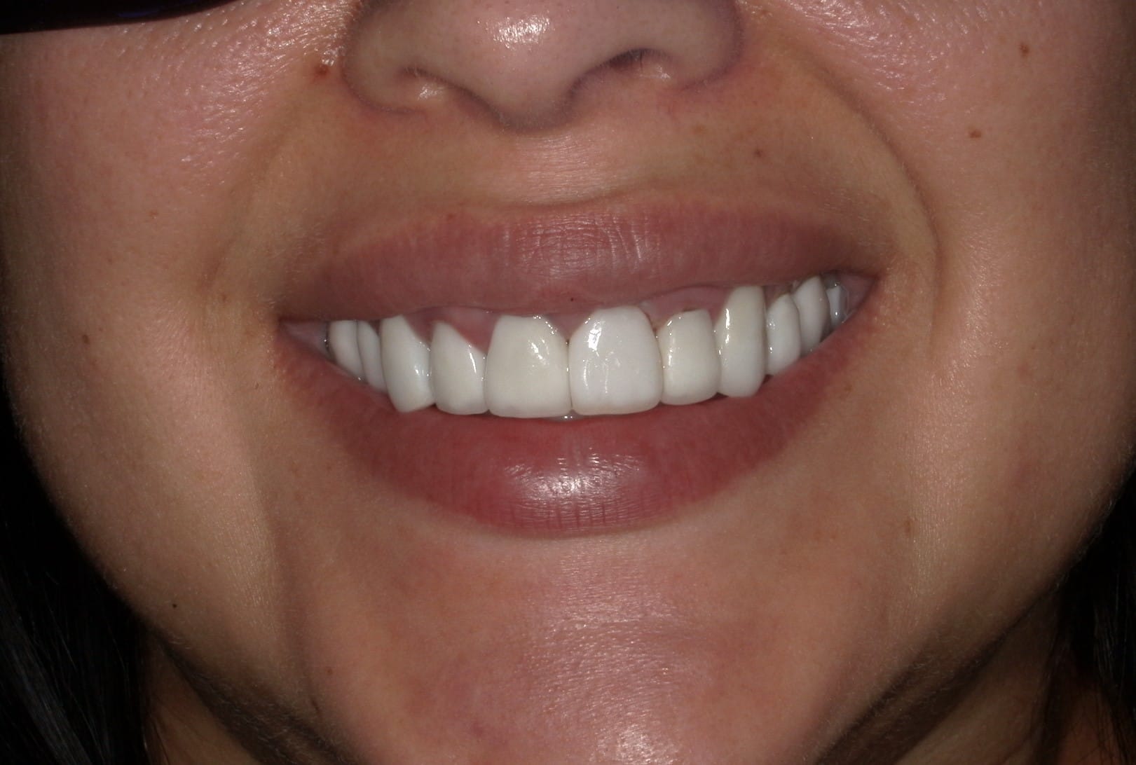 Teeth Whitening Tijuana