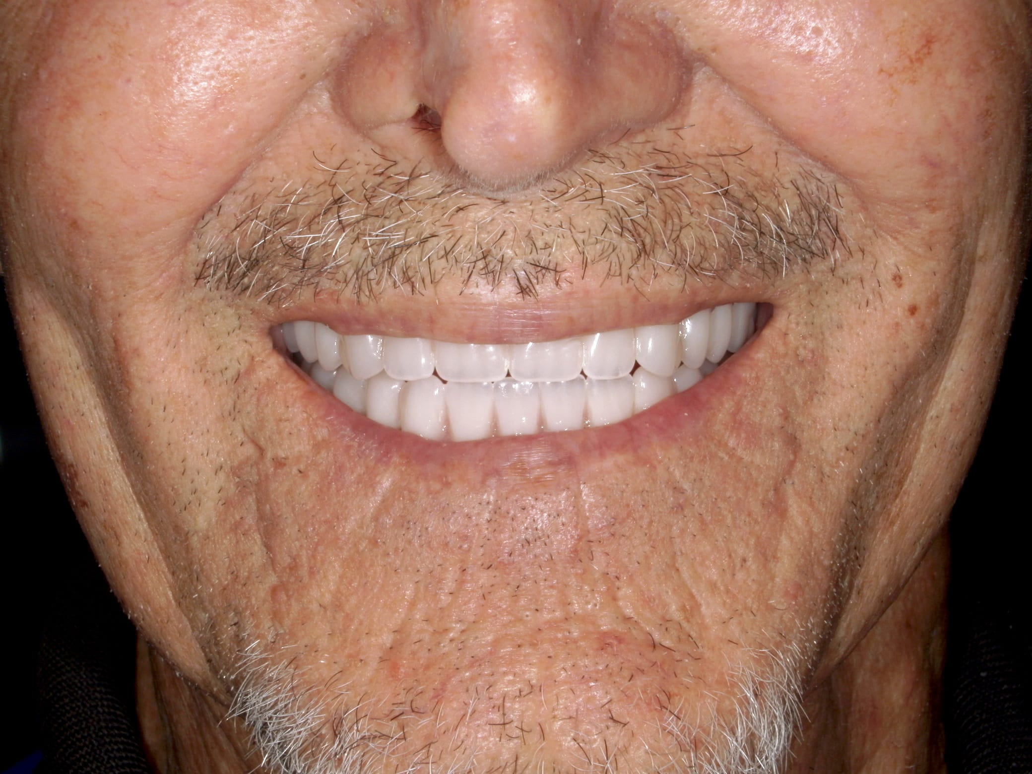 Dental Implants in Tijuana