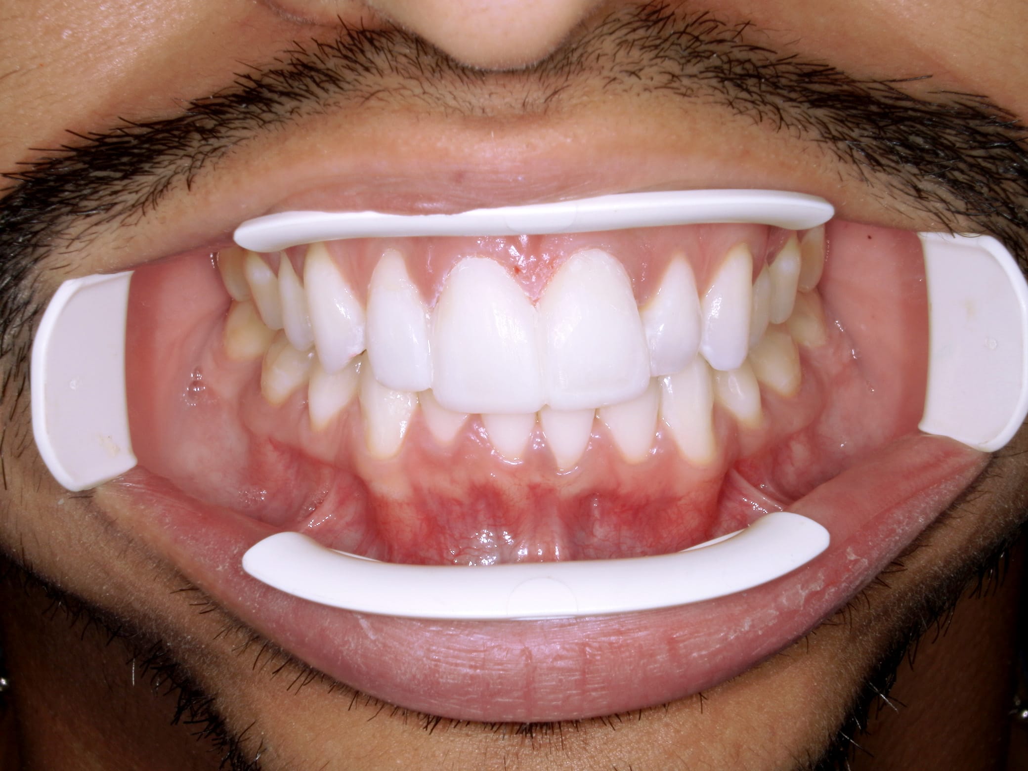 Best Teeth Whitening Tijuana