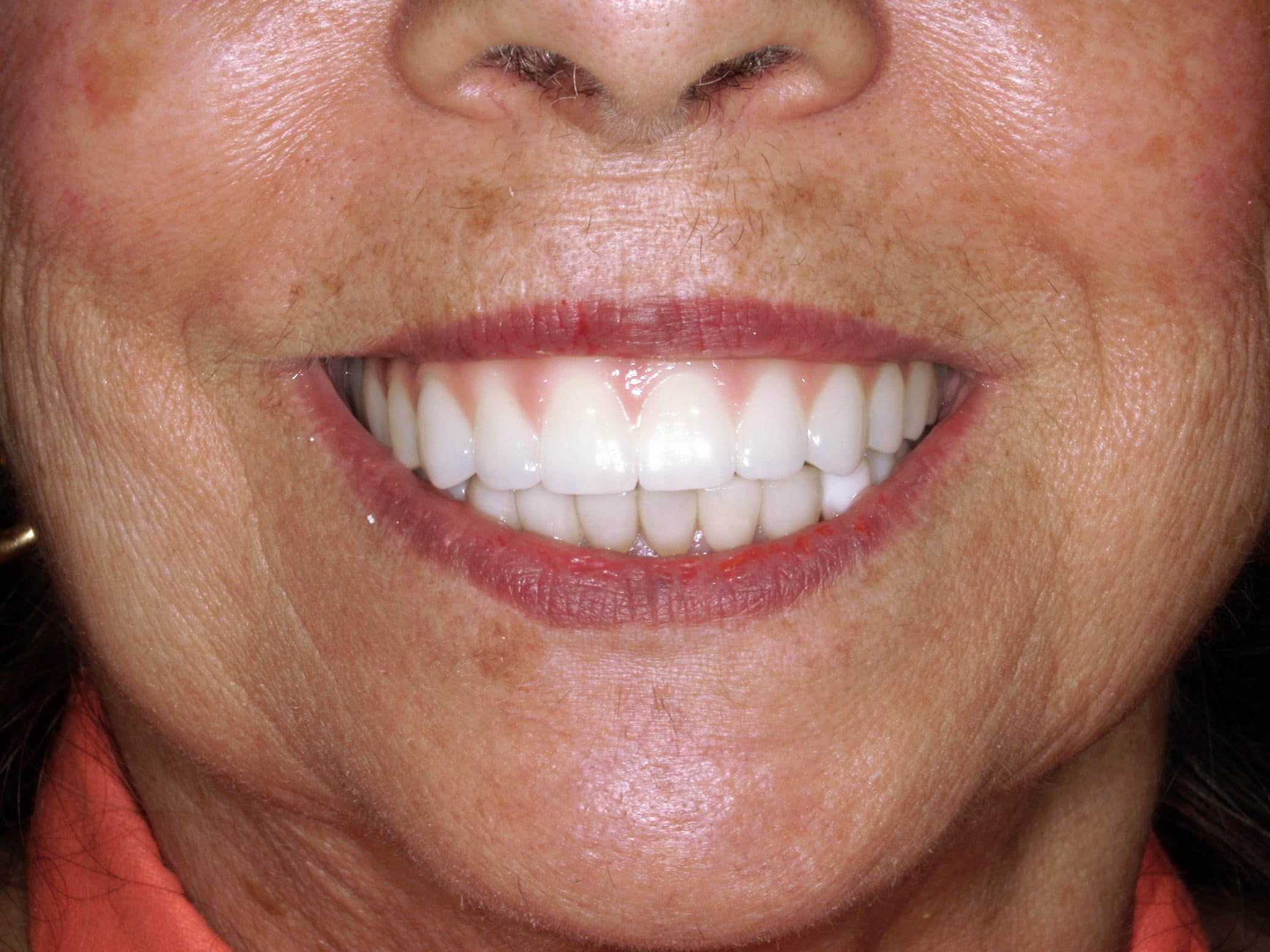 close up women smiling with a exellent denture