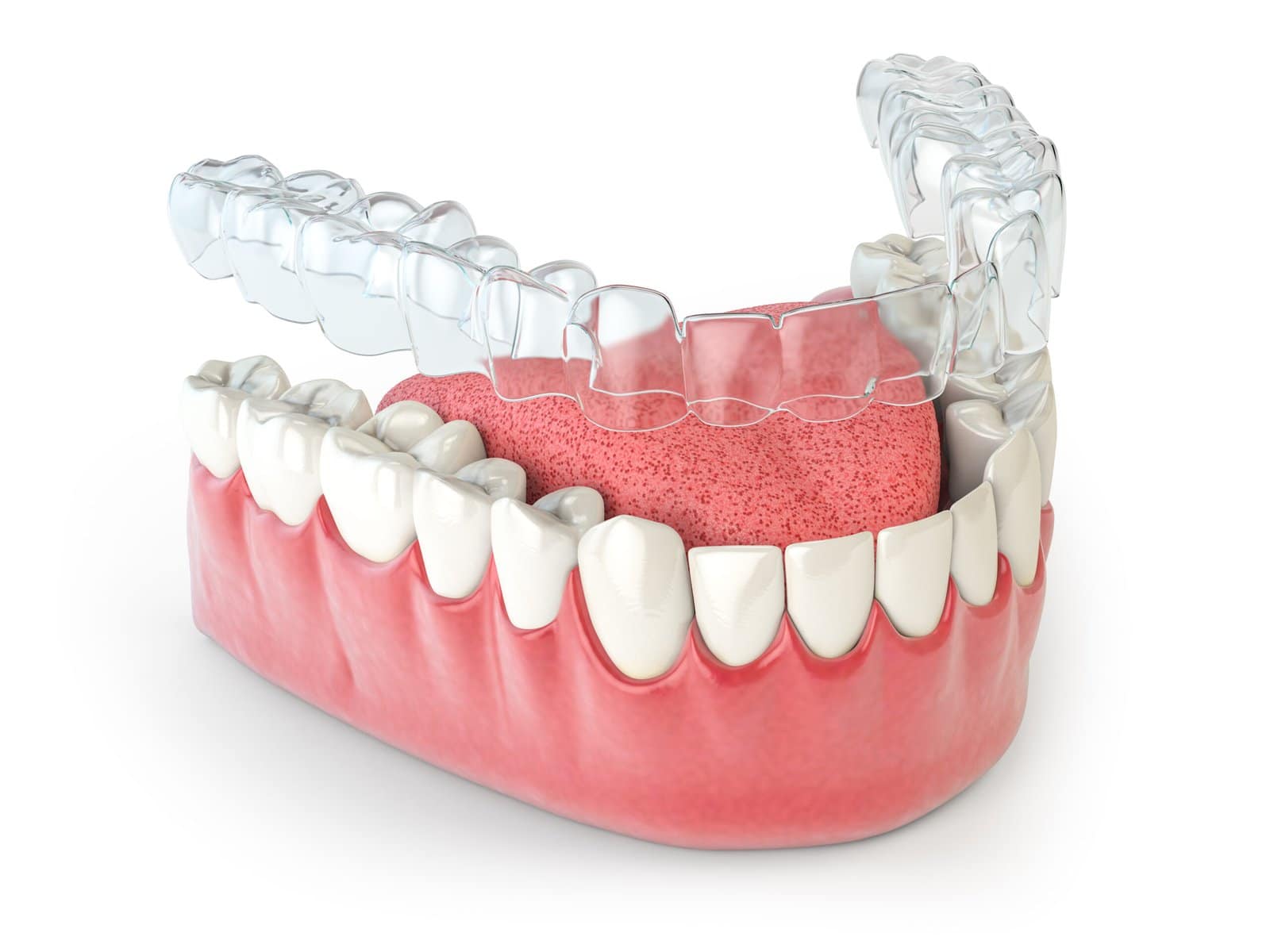 animated denture with a white background with invisalign on tooth