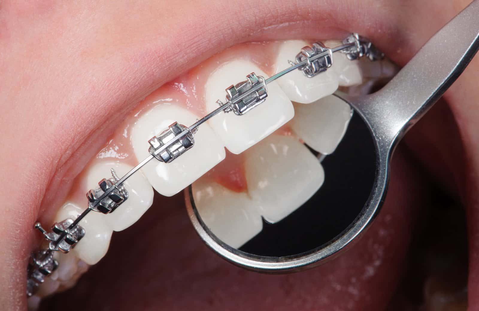 orthodontics in tijuana